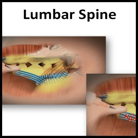 Module 3: Lumbar Spine