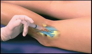 WHAT IS PROLOTHERAPY?